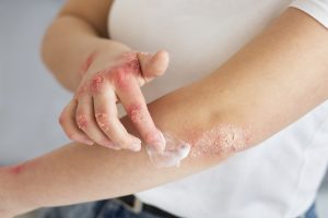 ¿Qué hacer ante una quemadura en casa?